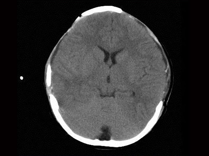 decompressive surgery cuts death in traumatic brain injury