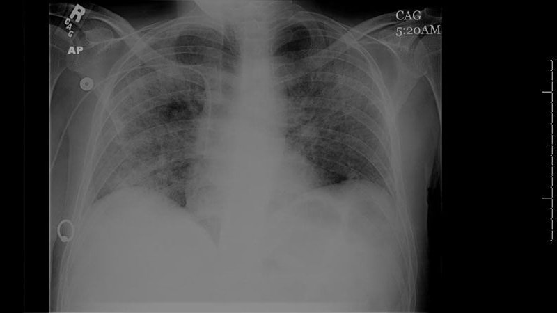 A 45-Year-Old Man With Shortness of Breath, Cough, and Fever - Page 5