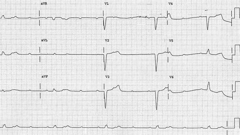 ECG Challenge: Lightheadedness and Extremely Slow Pulse