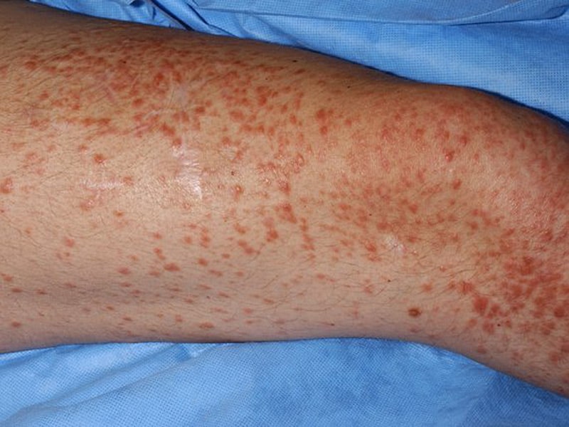 What Is Lymphoma Of The Skin