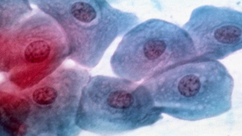 Cervical Cancer Screenings Linked to Preterm Births