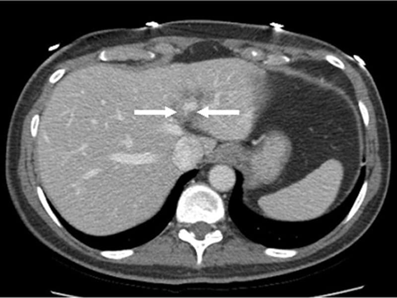 cancer-metastasis-causes-symptoms-and-metastasis-survival-rate