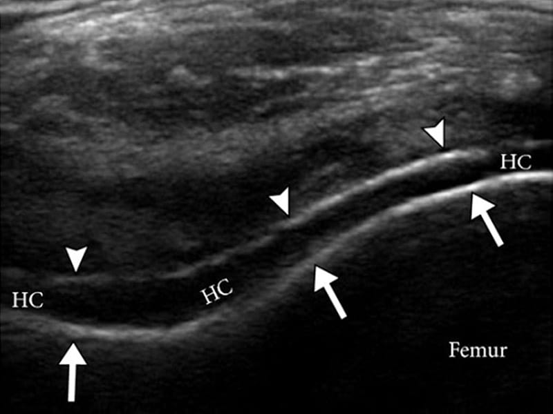 Gout Preliminary Definitions for Ultrasound Findings Issued