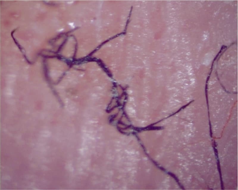 morgellons disease cure