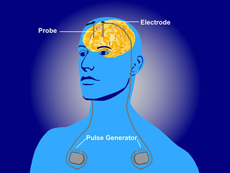 DBS for Severe Depression Fails in First ShamControlled Trial