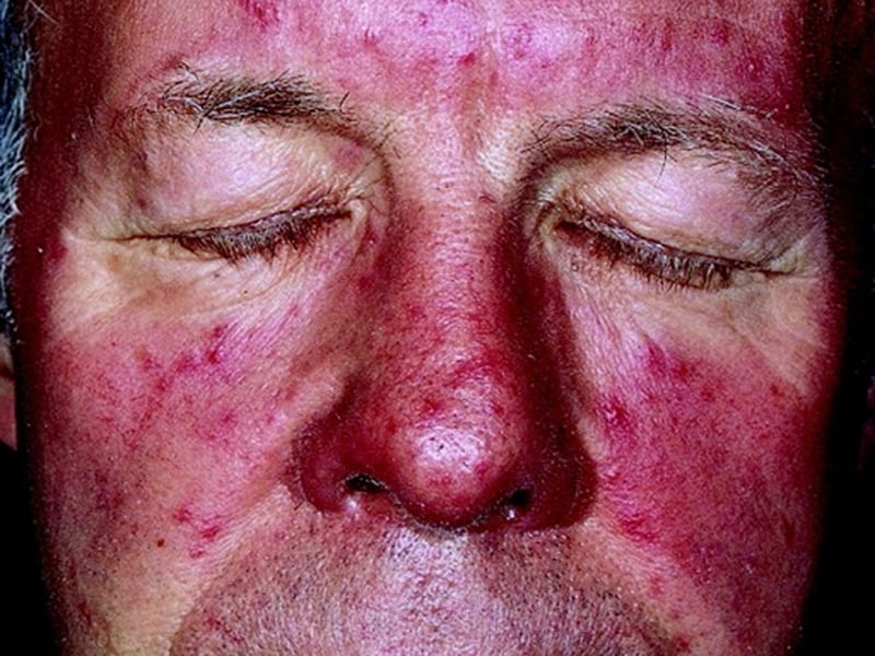 Rosacea Pictures 60