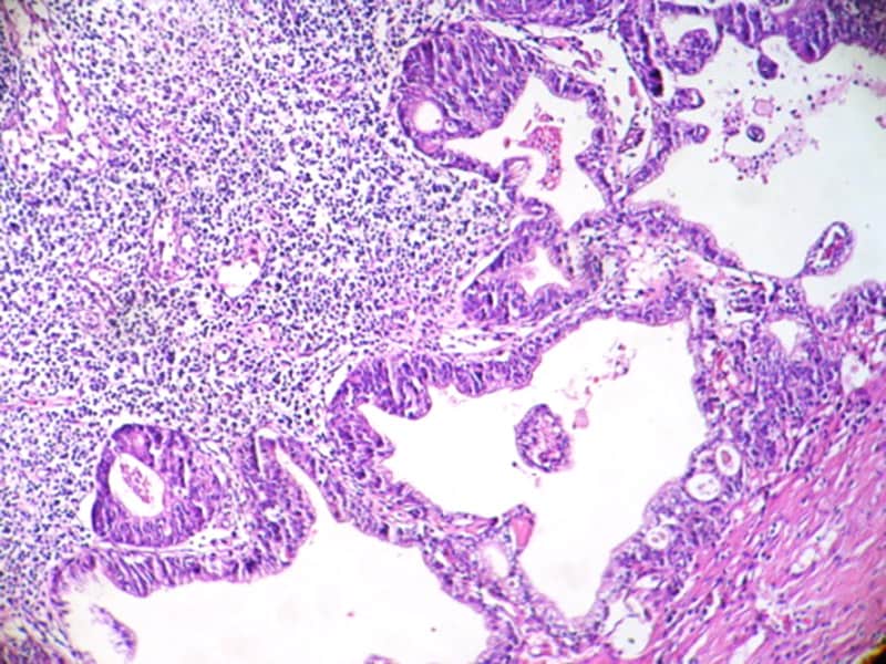 new-immunotherapy-ups-survival-in-metastatic-cervical-cancer