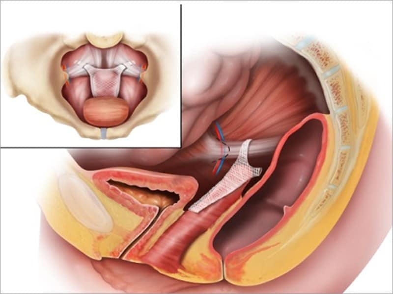 Curb on Mesh Implants for Stress Urinary Incontinence