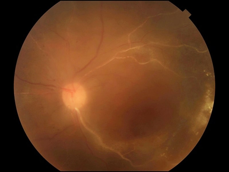 medical letter cme Case CMV Report Retinitis Ruxolitinib After Treatment: