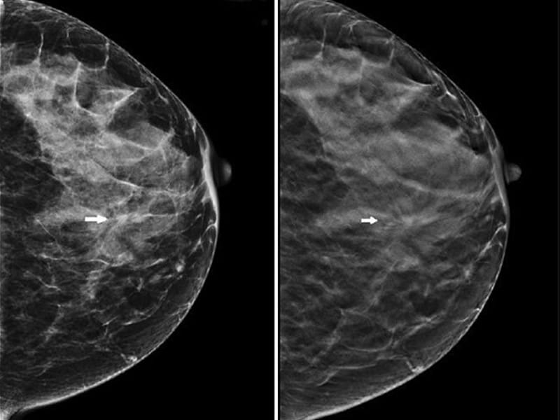 Маммография старый. Томосинтез молочной железы. Фиброкистоз маммография. Томосинтез молочных желез что это такое. Ретромаммарное пространство на маммографии.