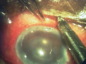 Amniotic Patch for Glaucoma Safe and Imperceptible