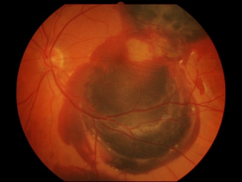 Dry senile macular degeneration