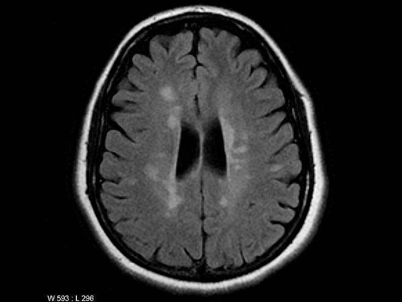 Amiselimod May Decrease Lesions in Relapsing MS Amiselimod May Decrease Lesions in Relapsing MS