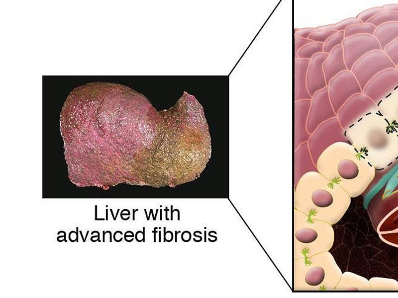 Liver Fibrosis Mechanism