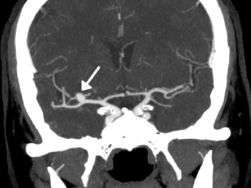 tool-may-predict-surgical-outcome-in-unruptured-aneurysm