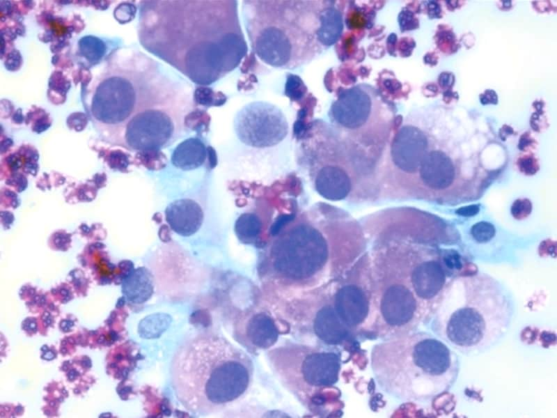 'Antiquated' Medullary Thyroid Cancer Staging Gets Update