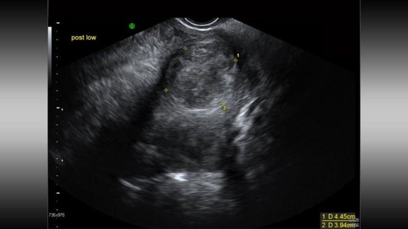 Medical Treatment of Fibroids With Heavy Menstrual Bleeding