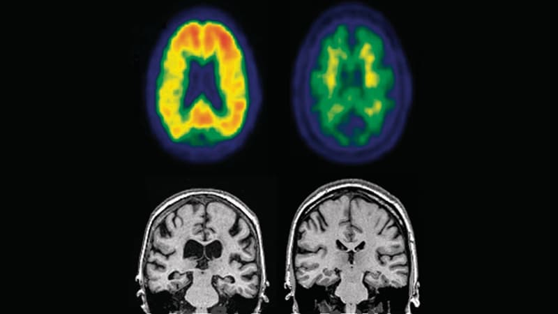 advanced-imaging-may-reveal-onset-of-cognitive-impairment