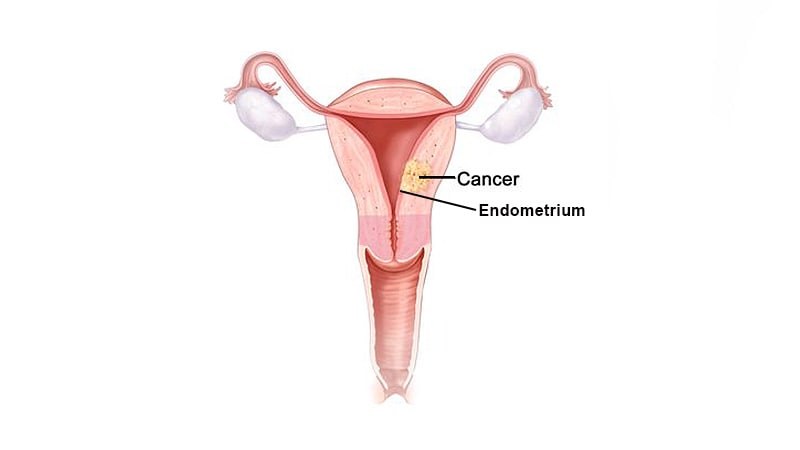 endometrial cancer medscape helminth worms in humans
