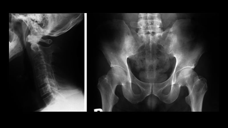 Les AINS peuvent masquer les résultats de l’IRM dans les cas de spondylarthrite