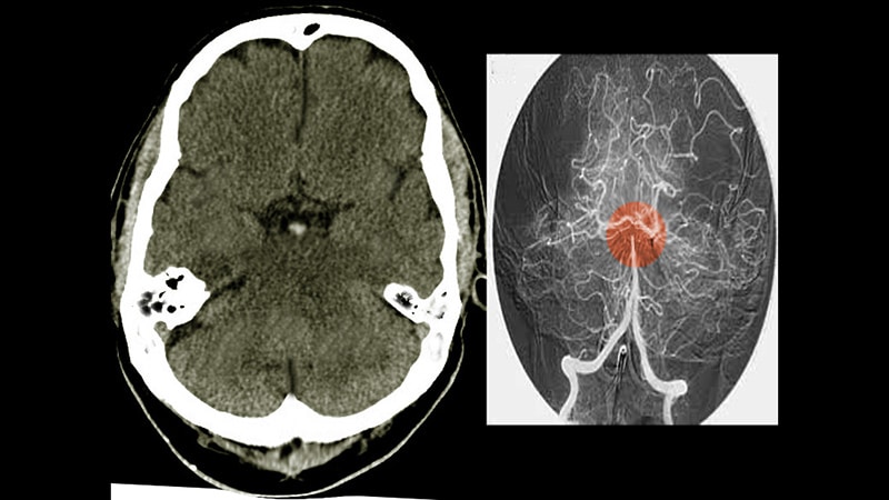 Endovascular Therapy for Stroke Due to Basilar-Artery Occlusion