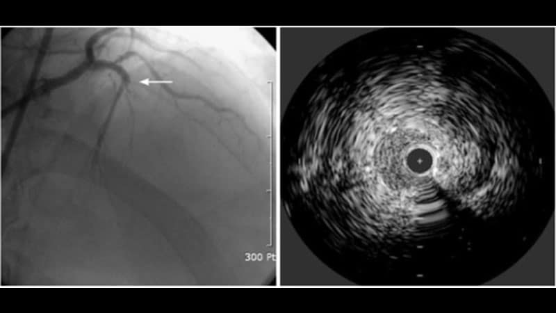 L’imagerie intravasculaire surpasse l’angiographie pour les ICP complexes