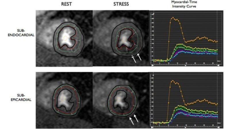 Stress Cardiovascular MRI Accurate, Prognostic in Chest Pain