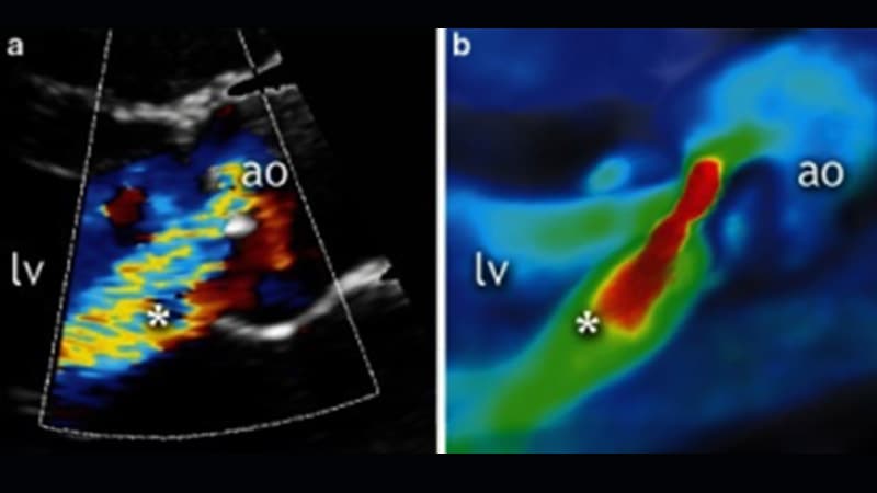Trilogy TAVR Sûr et efficace dans la régurgitation aortique