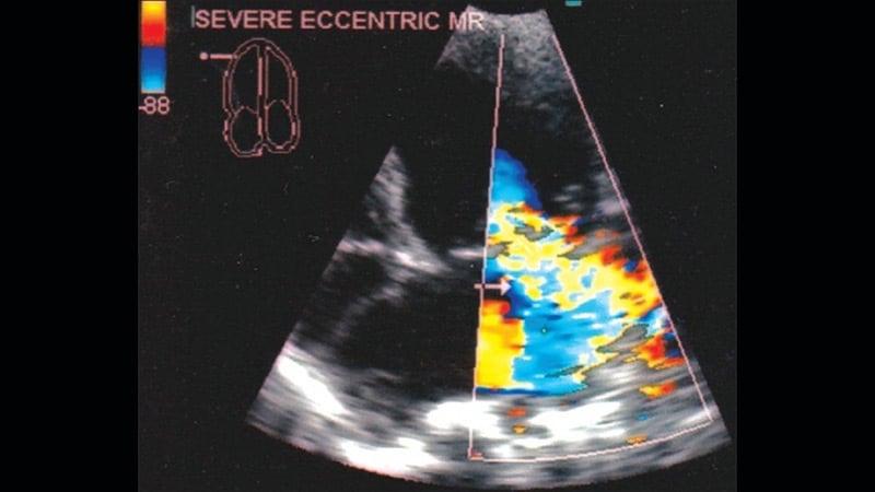 Transapical Valve Replacement Relieves Mitral Regurgitation