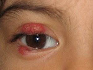 A 3-Year-Old Girl With Redness and Swelling of the Eyelid - Page 3