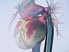 The Intra-aortic Balloon Pump In High-risk PCI - Page 4