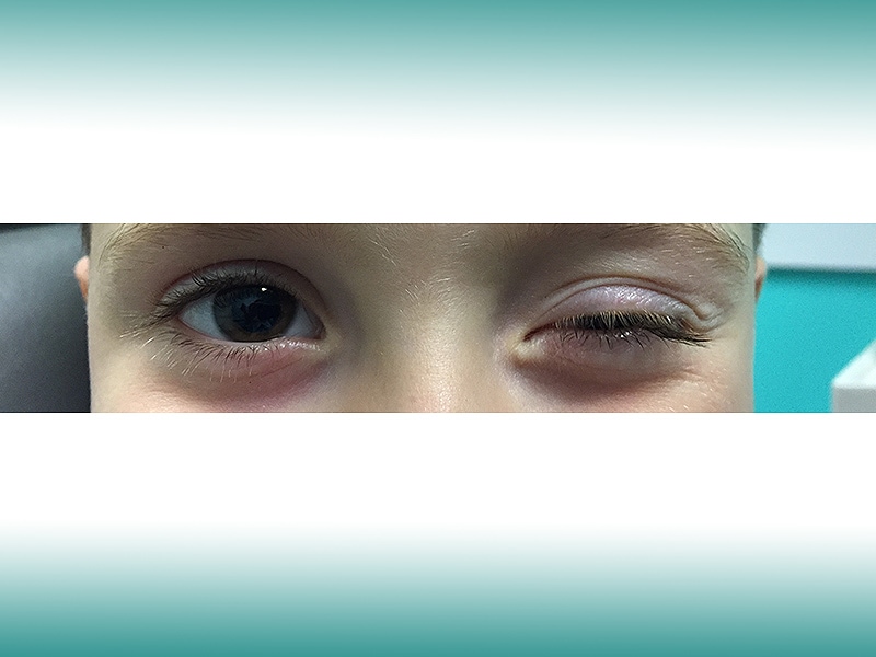 A Child With Involuntary And Intermittent Eyelid Movements