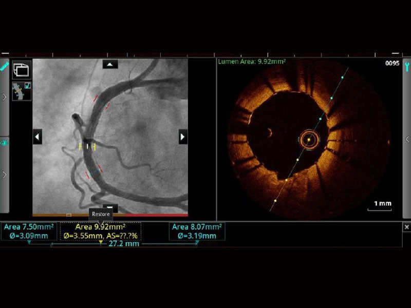 IVUS, OCT Imaging At PCI Seen To Boost Survival Vs Angiography