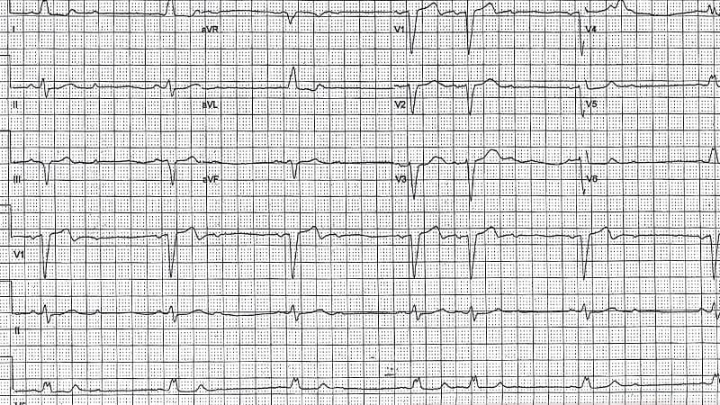 ECG Challenge: Lightheadedness and Slow, Irregular Pulse