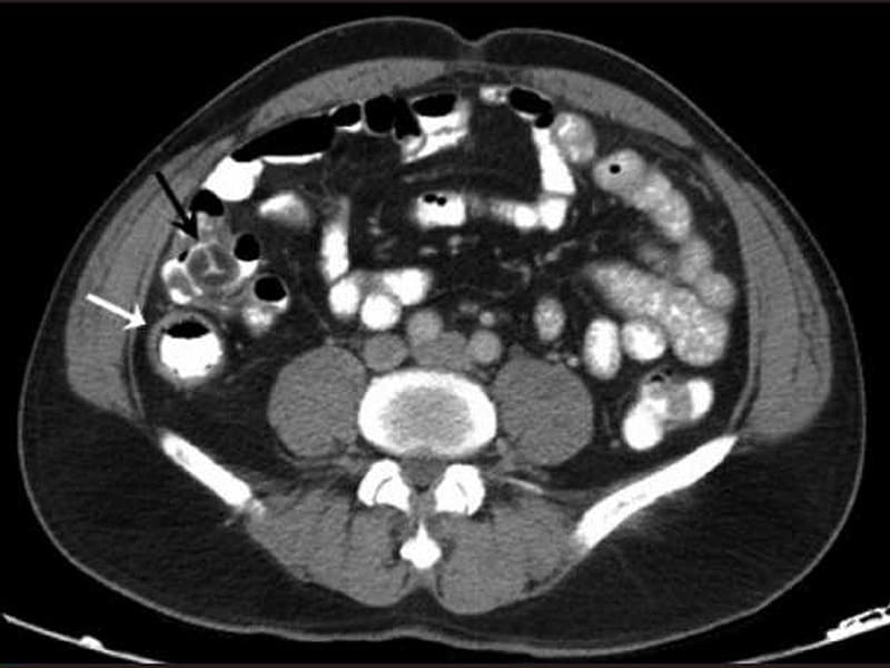 Does IV Contrast Cause Acute Kidney Injury?