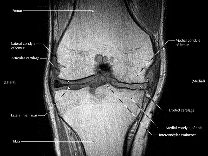 knee anatomy mri