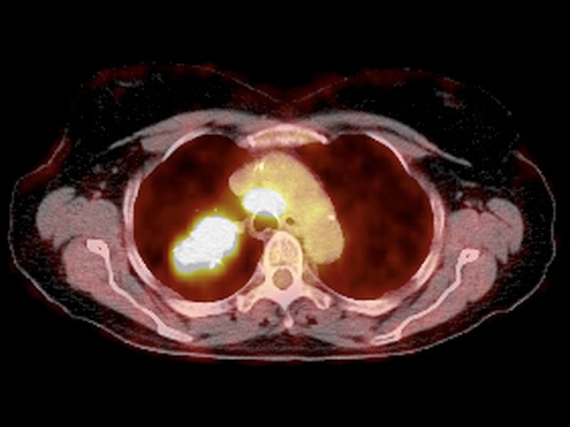 Body Scans Compare Primary, Metastatic Tumors in Lung Cancer