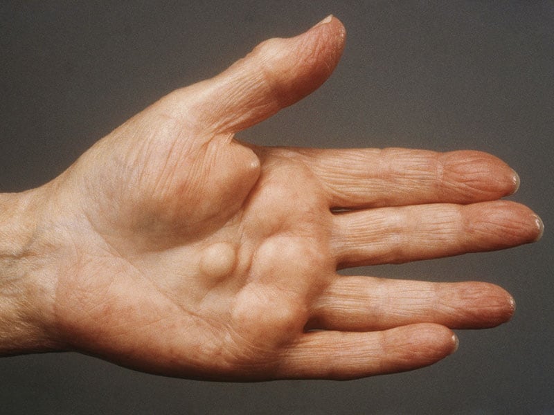 tendon-inflammation-in-the-hand-predicts-future-arthritis