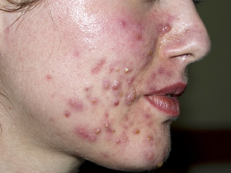 Acne: Antibiotic Use Regularly Exceeds Recommended Duration