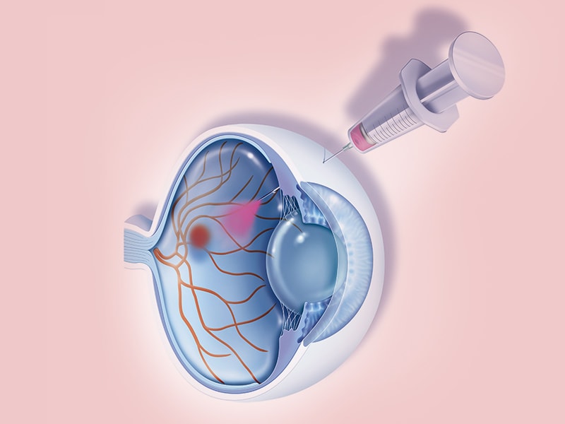 Response to Anti-VEGF in Macular Edema Evident at 3 Months