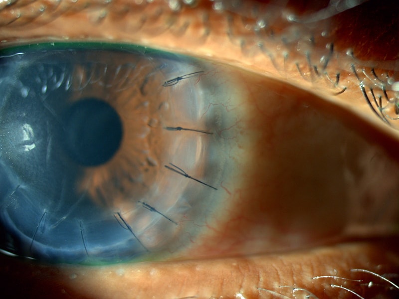 How much is corneal transplant surgery