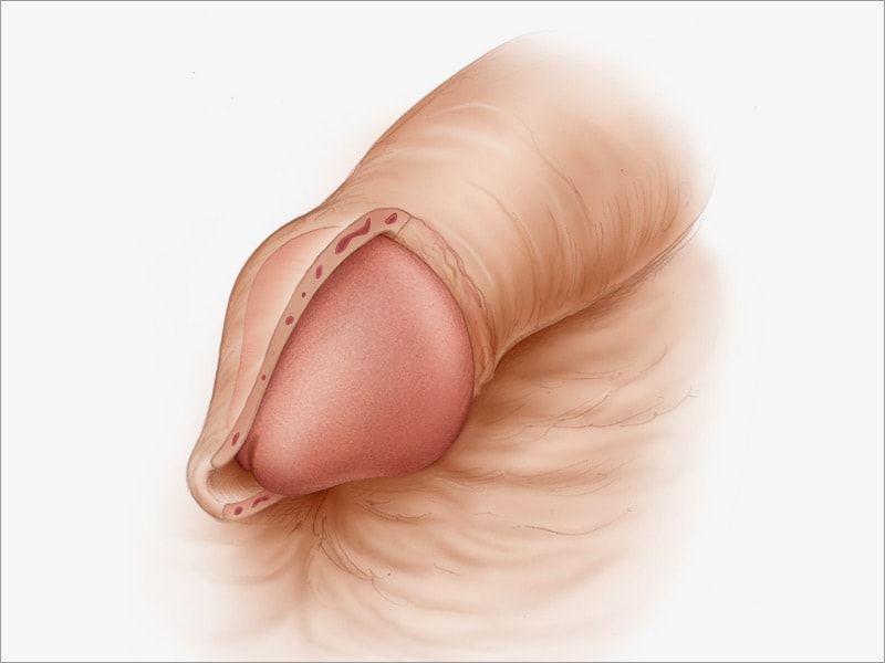 Circumcised Male Penis 82