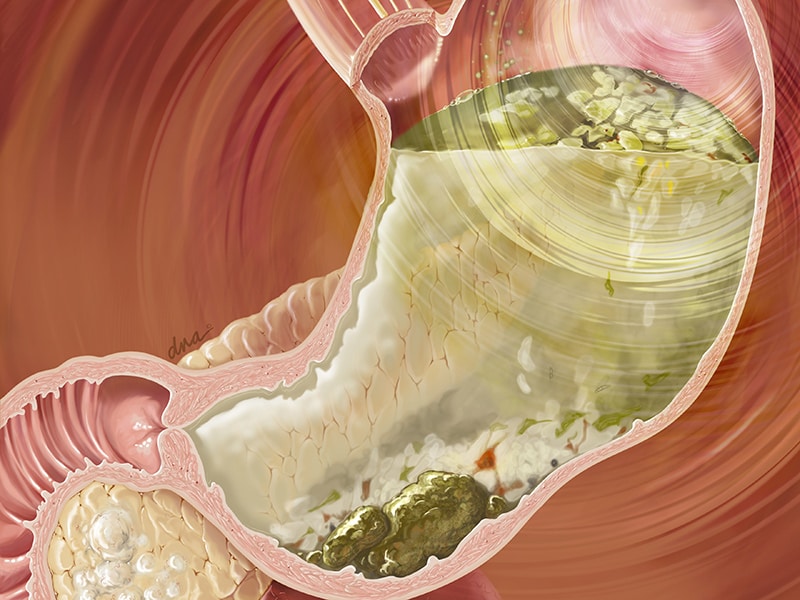 Gastric Endoscopic Myotomy Showing Promise for Gastroparesis