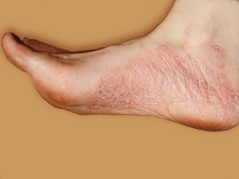 palmoplantar psoriasis on feet treatment