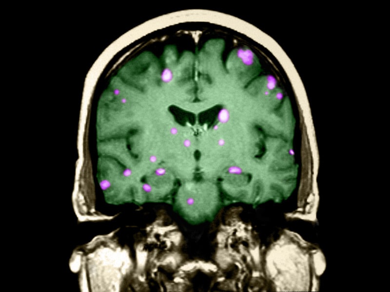 In HER2 Breast Cancer, Brain Mets Are HER2+ 20 of Time