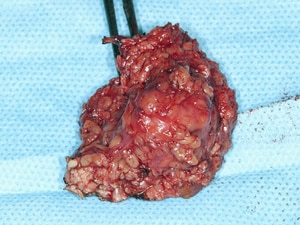 New US Cancer Staging System Debuts in 9 Months