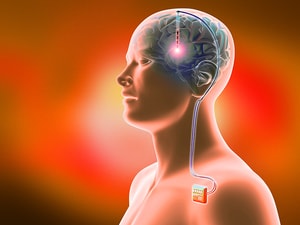Deep Brain Stimulation May Offer Hope for Severe Schizophrenia
