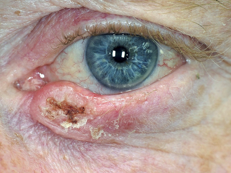 Steady Increase In Eyelid Cancer Found In England