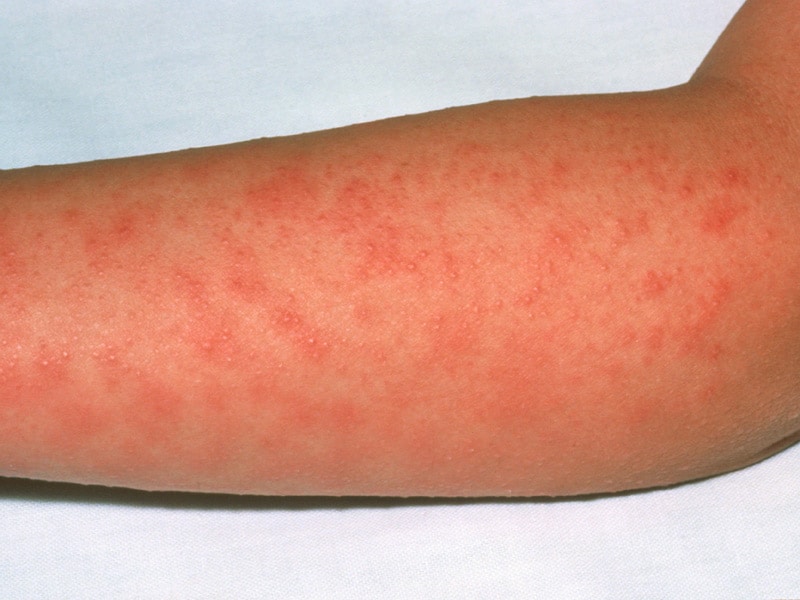 new-strep-a-strain-linked-to-scarlet-fever-and-sepsis