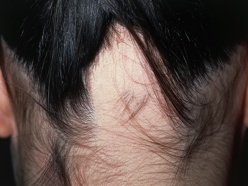 Novel Study of Endocrine Therapy-Induced Hair Loss